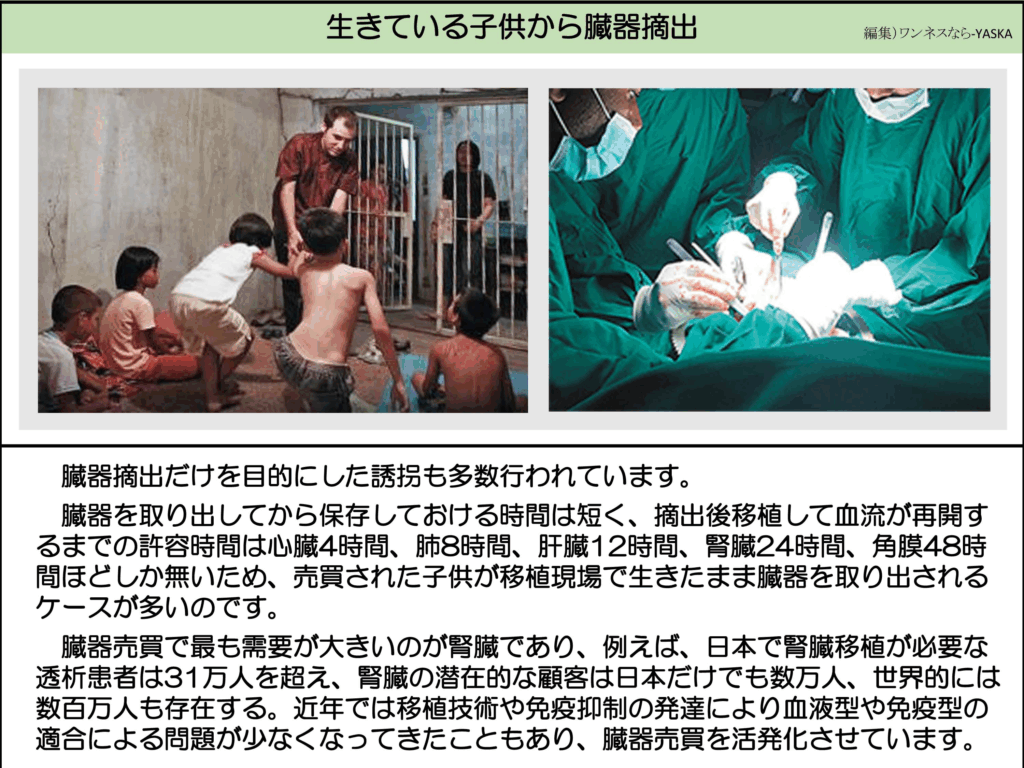 臓器摘出だけを目的にした誘拐も多数行われています。
臓器を取り出してから保存しておける時間は短く、摘出後移植して血流が再開するまでの許容時間は心臓4時間、肺8時間、肝臓12時間、腎臓24時間、角膜48時間ほどしか無いため、売買された子供が移植現場で生きたまま臓器を取り出されるケースが多いのです。
臓器売買で最も需要が大きいのが腎臓であり、例えば、日本で腎臓移植が必要な透析患者は31万人を超え、腎臓の潜在的な顧客は日本だけでも数万人、世界的には数百万人も存在する。近年では移植技術や免疫抑制の発達により血液型や免疫型の適合による問題が少なくなってきたこともあり、臓器売買を活発化させています。