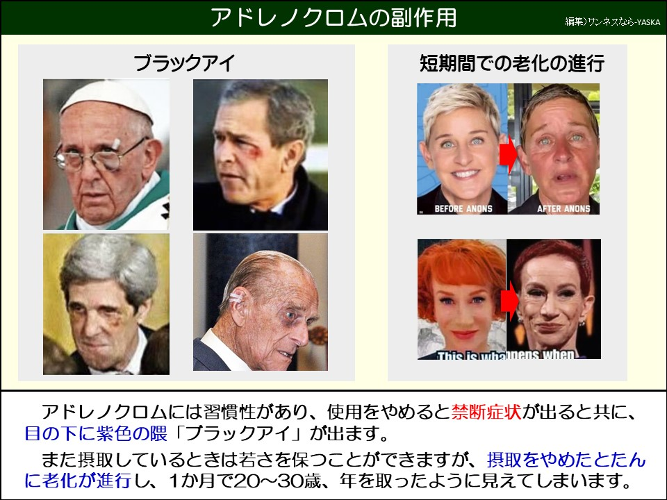 アドレノクロムの副作用

ブラックアイ

短期間での老化の進行

アノンズ前

アノンズ後

これはウィハブネンスです

アドレノクロムには習慣性があり、使用をやめると禁断症状が出ると共に、 目の下に紫色の隈「ブラックアイ」が出ます。

また摂取しているときは若さを保つことができますが、摂取をやめたとたんに老化が進行し、1か月で20~30歳、年を取ったように見えてしまいます。